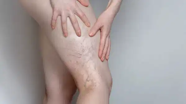 Uzmanından uyarı: ‘İleri derecedeki varis hayatı tehdit edebilir’